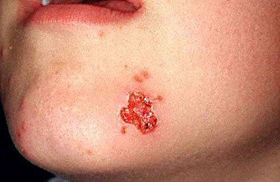 Can You Get Cold Sores on the Chin?