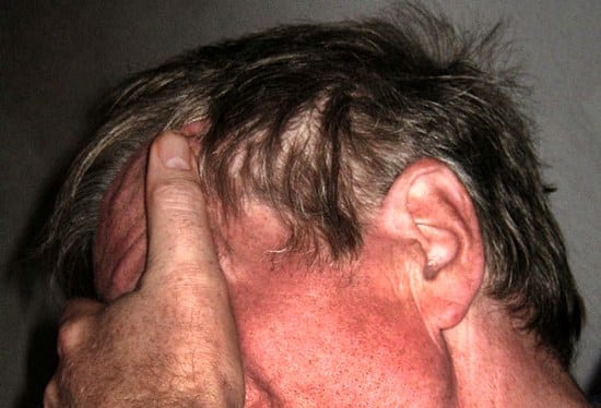 Can Cold Sores Cause Nerve Pain In Face -Can You Get Facial (Trigeminal) Nerve Pain After a Cold Sore?