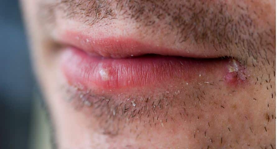 Which Is The Worst Cold Sores Stage?