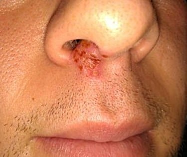 Cold Sores Below the Nose