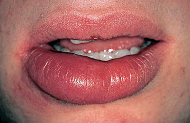 How to Reduce Cold Sore Swelling Quickly