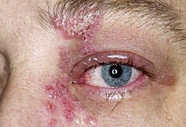 What is Ocular Herpes?